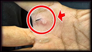 ASMR BARBER Removal of ingrown hair in my Hend ingrown hair removal [upl. by Lillith]