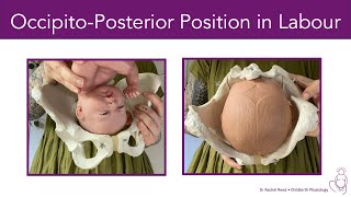 OccipitoPosterior Position BacktoBack in Labour [upl. by Tia]