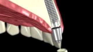 3D Medical Animation of a Dental Implant [upl. by Buddie949]