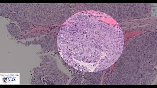 Ureter Papillary urothelial carcinoma Microscopy  Talking slide [upl. by Threlkeld906]