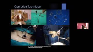 Two Level Recurrent Disc Herniation Endoscopic Decompression [upl. by Initsed709]