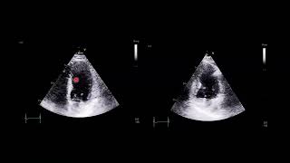 Echocardiogram of a ventricular septal defect VSD complicating acute myocardial infarction [upl. by Yvon957]