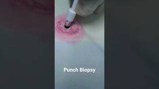 Punch Biopsy Technique doctor hospital [upl. by Kampmeier]