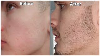 Minoxidil Beard Growth  3 Month Transformation  BEFORE and AFTER [upl. by Sang616]