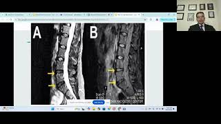 Navneet bodduRole of mesenchymal stemcells for systemic illnesses [upl. by Bank445]