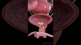 🪨 Bladder Stones What You Need to Know 🪨 anatomy [upl. by Demetrius]