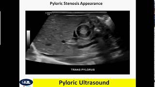 Pyloric ultrasound [upl. by Gwenette165]