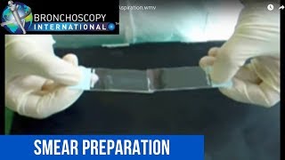 Smear Preparation after Bronchoscopic Needle Aspiration [upl. by Hector897]