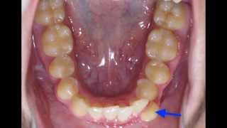 Lower Crowding Non Extraction Kyger Orthodontics [upl. by Westley]