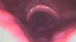 sleep endoscopy with circumferential retropalatal collapse [upl. by Fagen]