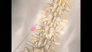 What is lumbar facet Radiofrequency ablation Treatment for lower back pain [upl. by Thurman751]