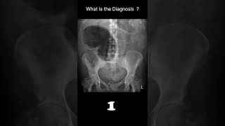 Caecal volvulusAbdominal Xray  Abnormalities  Caecal volvulus 76 radiologychannel007 [upl. by Phelips791]