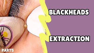 Blackhead extraction Relax with bye pimple💜 [upl. by Euv]