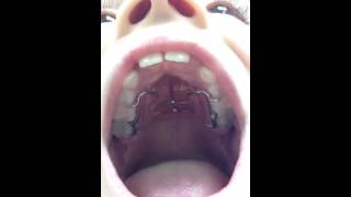 Palatal Expander Getting Braces On Nirenblatt Orthodontics [upl. by Jagir812]