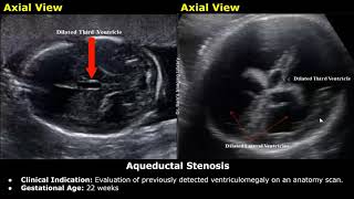 Fetal Brain Ultrasound Reporting  Obstetric Brain Pathologies Scan Reports  Pregnancy USG [upl. by Siri254]