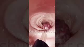 Colonoscopy ulcers colon medicalimagingcolonoscopy medicalanimation [upl. by Tega]