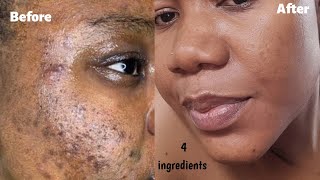 GET RID OF PIMPLES amp ACNE IN 7 DAYS  How to fade darkspots amp get a clear glowing skin [upl. by Ruthe]