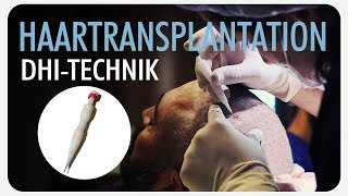 Haartransplantation  Die DHI Methode einfach erklärt [upl. by Benyamin]