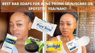 BEST SOAPS FOR MY ACNE PRONE SKIN ACNE SPOT DARK MARKS IMPERFECTIONS 2020 [upl. by Eloken950]