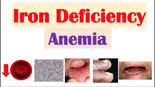 IronDeficiency Anemia Overview  Causes Pathophysiology Signs amp Symptoms Diagnosis Treatment [upl. by Julia799]