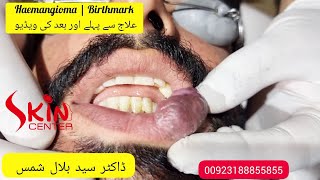 Haemangioma  birthmark treatment with laser  Dermatologist  Dr Bilal Shams skincenterpakistan [upl. by Bonucci]