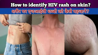 How to identify HIV rashes on the bodyhiv spots ko skin par kaise pahchane hivrash rashonskin [upl. by Giglio421]