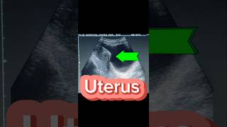 Mass in Uterus  Mixed Echogenic lesion  Fibroid on Ultrasound [upl. by Evette]