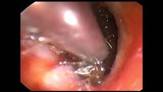 Gros bouchon de cérumen earwax removal JB DANVIN 3 [upl. by Aeslehc]