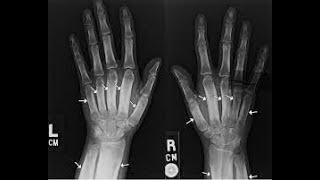 Radiology Hypertrophic osteoarthropathy concept for NEETPGFMGEINICETNEXT [upl. by Melburn]