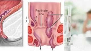 External Hemorrhoids Treatment [upl. by Lotsirb347]