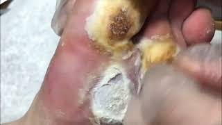 Pedicure video17，vertical plantaris，plantar wart [upl. by Doomham]