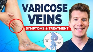 Varicose Veins Explained Causes Symptoms amp Treatment [upl. by Archer]