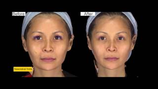 Ellanse procedure at ShangLi Dermatologic amp Aesthetic Clinic [upl. by Anar]