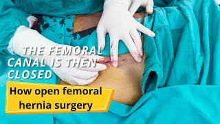 How open femoral hernia surgery with Mesh [upl. by Anima]