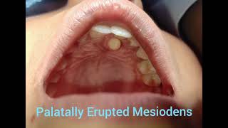 Palatally Erupted Mesiodens  Extraction  Bright Line Dental Care  Kuleshwor Nepal  Nepalidentist [upl. by Posner]