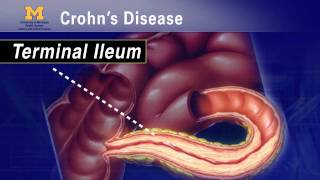 IBD School 102  What is Crohns Disease [upl. by Nylynnej640]