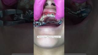 Removal of a palatal expander for orthodontic treatment braces satisfying orthodontist [upl. by Weinrich]