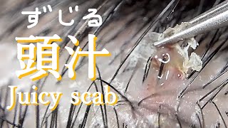 No164「頭汁」浸出液の溜り池  Exudate juicy scab  exudado costra jugosa  滲出多汁痂  육즙이 많은 딱지가 삼출됩니다 [upl. by Leckie]