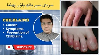 ChilblainsPrenio Treatment and Home Remedies For Chilblains سردیوں میں انگلیوں اور پائوں کی سوزش [upl. by Godbeare]