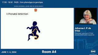 E081  Phenotypic spectrum of Fetal akinesia deformation sequence [upl. by Richia248]