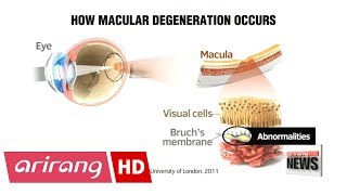 Korean traditional foods prove effective in alleviating macular degeneration [upl. by Erlewine]