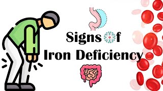 Signs Of Iron Deficiency What Are The Signs amp Symptoms Of Iron Deficiency Anemia IDA [upl. by Eicats807]