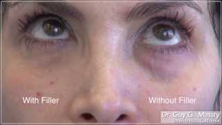 Under Eye Filler Injections With Dr Massry  Beverly Hills [upl. by Feer]