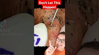 Record Dark BLACKHEADS REMOVAL  Dont Let This Happen shorts [upl. by Elenore]