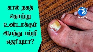 கால் நகத் தொற்று உண்டாக்கும் ஆபத்து பற்றி தெரியுமா Treat toenail fungal infection  treatment [upl. by Isleen]