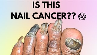 IS THIS NAIL CANCER symptoms  HOW TO IDENTIFY NAIL CANCER  SUBUNGUAL MELANOMA  MELANOMA [upl. by Liamaj472]