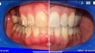 Invisalign treatment before and after with Virtual tracking time lapse [upl. by Eliak]