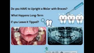 Do you HAVE to Upright a Tipped Molar Risks Benefits and Alternatives [upl. by Amaleta]