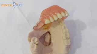 Definitive obturator maxillofacial prosthesis [upl. by Esinehc]