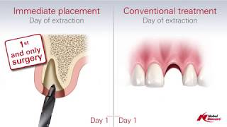 Immediate Placement vs Conventional Treatment Dental Implants [upl. by Brynn169]